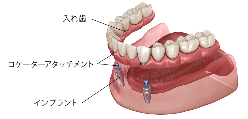 ロケーターアタッチメントインプラントデンチャー